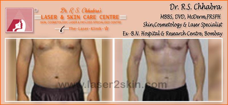 Tummy Reduction With Thermo-Cav Lipo Laser Therapy by Dr R.S. Chhbara