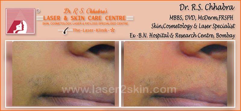 laser hair Removal by Dr R.S. Chhbara laser hair Removal by Dr R.S. Chhbara