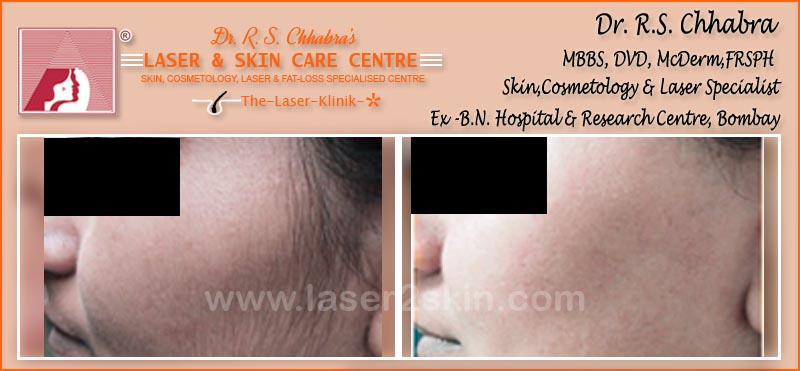 laser hair Removal by Dr R.S. Chhbara laser hair Removal by Dr R.S. Chhbara