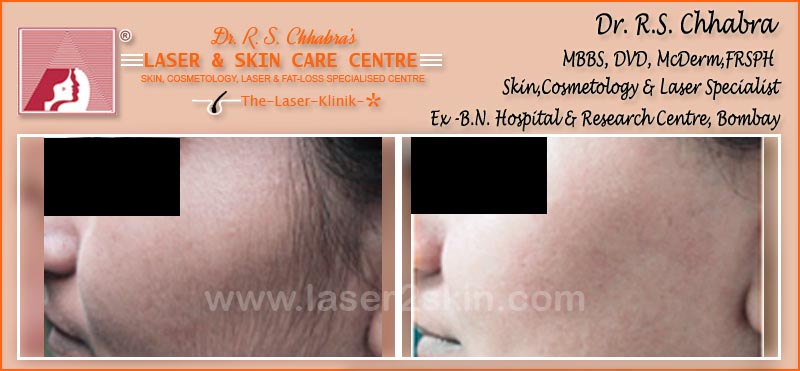 laser hair Removal by Dr R.S. Chhbara