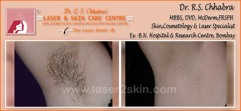 laser hair Removal by Dr R.S. Chhbara laser hair Removal by Dr R.S. Chhbara