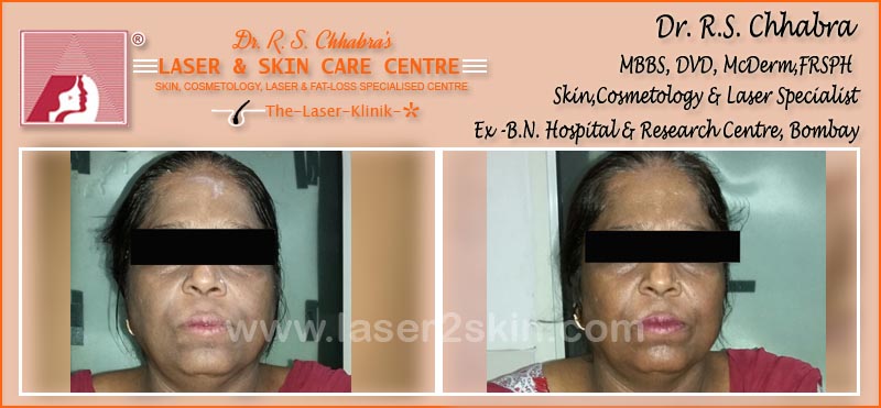 Oxy Derma Therapy by Dr R.S. Chhbara Oxy Derma Therapy by Dr R.S. Chhbara