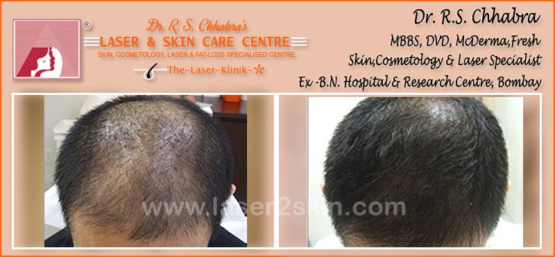 PDT Hair Fall Control With PDT Therapy by Dr R.S. Chhbara