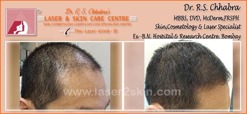 PDT Hair Fall Control With PDT Therapy by Dr R.S. Chhbara PDT Hair Fall Control With PDT Therapy by Dr R.S. Chhbara