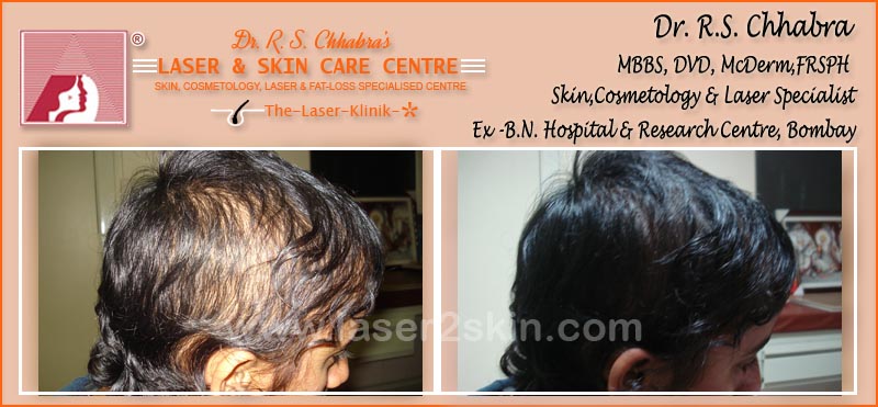 PDT Hair Fall Control With PDT Therapy by Dr R.S. Chhbara PDT Hair Fall Control With PDT Therapy by Dr R.S. Chhbara