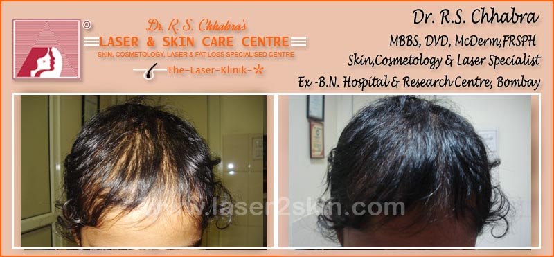 PDT Hair Fall Control With PDT Therapy by Dr R.S. Chhbara PDT Hair Fall Control With PDT Therapy by Dr R.S. Chhbara