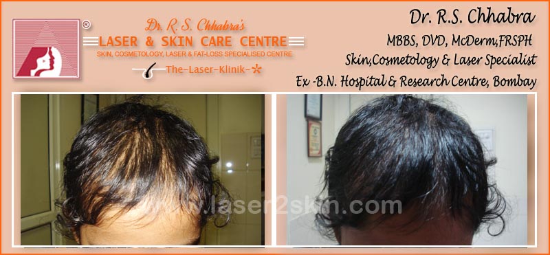 PDT Hair Fall Control With PDT Therapy by Dr R.S. Chhbara