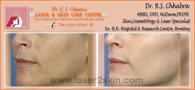 Facial Rejuvenation Instant Glow With Photofacial by Dr R.S. Chhbara Facial Rejuvenation Instant Glow With Photofacial by Dr R.S. Chhbara