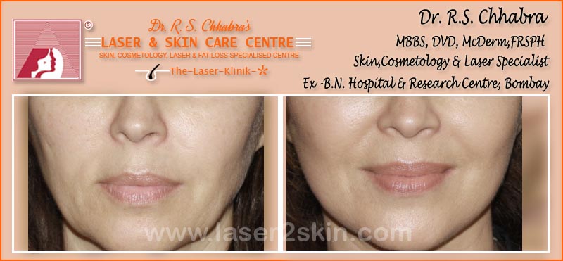 Facial Rejuvenation Instant Glow With Photofacial by Dr R.S. Chhbara Facial Rejuvenation Instant Glow With Photofacial by Dr R.S. Chhbara