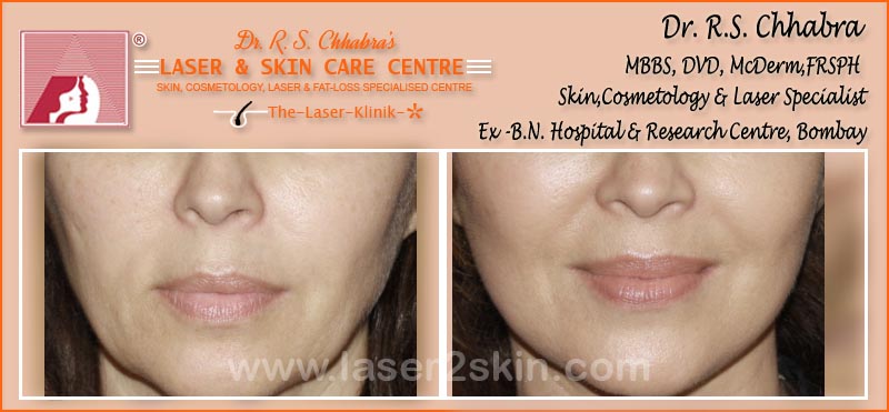 Facial Rejuvenation Instant Glow With Photofacial by Dr R.S. Chhbara