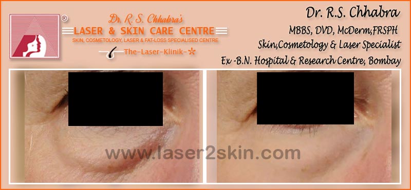 Puffy Eyes treatment With Thermo-Cav Lipo Laser Therapy by Dr R.S. Chhbara Puffy Eyes treatment With Thermo-Cav Lipo Laser Therapy by Dr R.S. Chhbara
