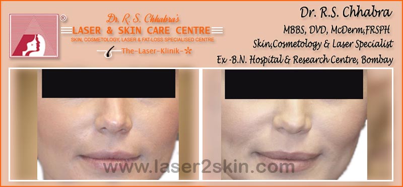 Skin Rejuvenation Instant Glow with Mesotherapy by Dr R.S. Chhbara