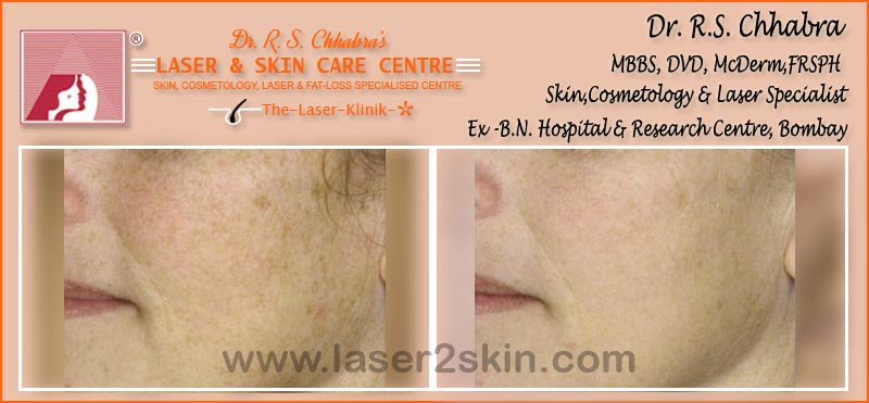 Skin Rejuvenation Instant Glow with Mesotherapy by Dr R.S. Chhbara Skin Rejuvenation Instant Glow with Mesotherapy by Dr R.S. Chhbara
