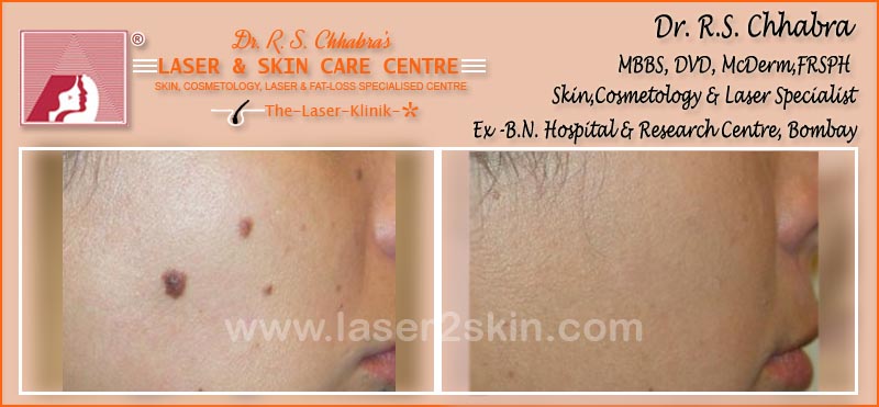 Skin Tags Treatment With Radio-Freq. Cauterisation by Dr R.S. Chhbara Skin Tags Treatment With Radio-Freq. Cauterisation by Dr R.S. Chhbara
