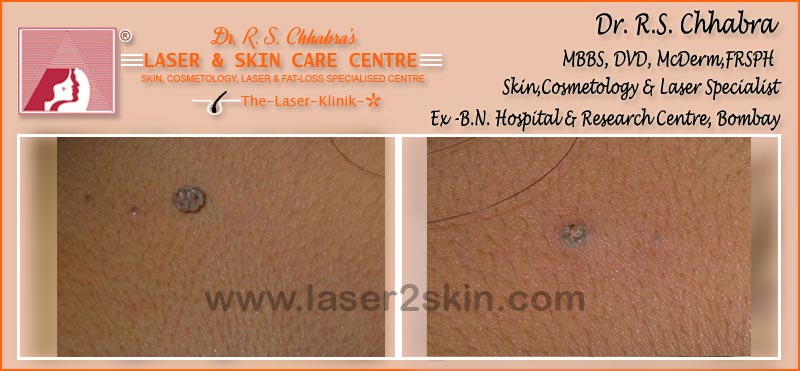 Skin Tags Treatment With Radio-Freq. Cauterisation by Dr R.S. Chhbara