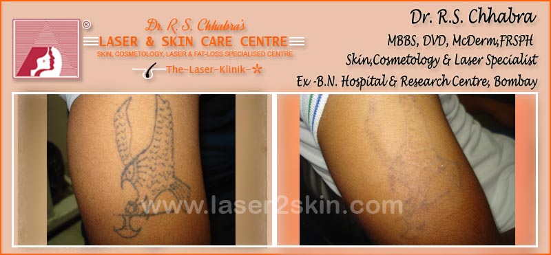 Tattoo Removal With Q-Switch Laser by Dr R.S. Chhbara