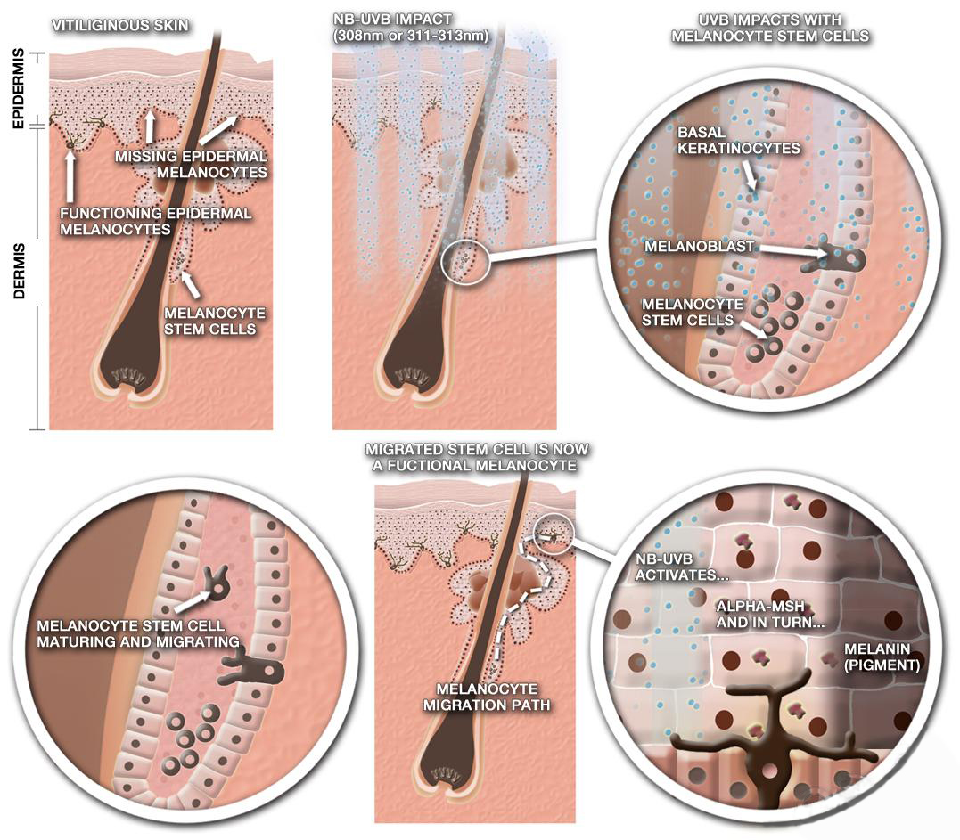Vitiligo(Leucoderma) Psoriasis With Microphototherapy spot Light Laser by Dr R.S. Chhbara Vitiligo(Leucoderma) Psoriasis With Microphototherapy spot Light Laser by Dr R.S. Chhbara