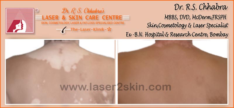 Vitiligo(Leucoderma) Psoriasis With Microphototherapy spot Light Laser by Dr R.S. Chhbara Vitiligo(Leucoderma) Psoriasis With Microphototherapy spot Light Laser by Dr R.S. Chhbara