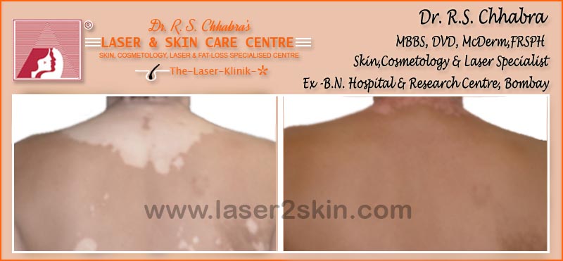 Vitiligo(Leucoderma) Psoriasis With Microphototherapy spot Light Laser by Dr R.S. Chhbara