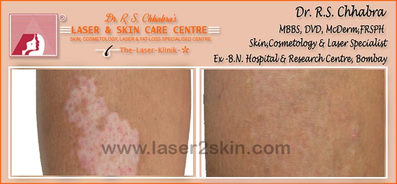 Vitiligo(Leucoderma) Psoriasis With Microphototherapy spot Light Laser by Dr R.S. Chhbara