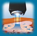 Vitiligo(Leucoderma) Psoriasis With Microphototherapy spot Light Laser Vitiligo(Leucoderma) Psoriasis With Microphototherapy spot Light Laser