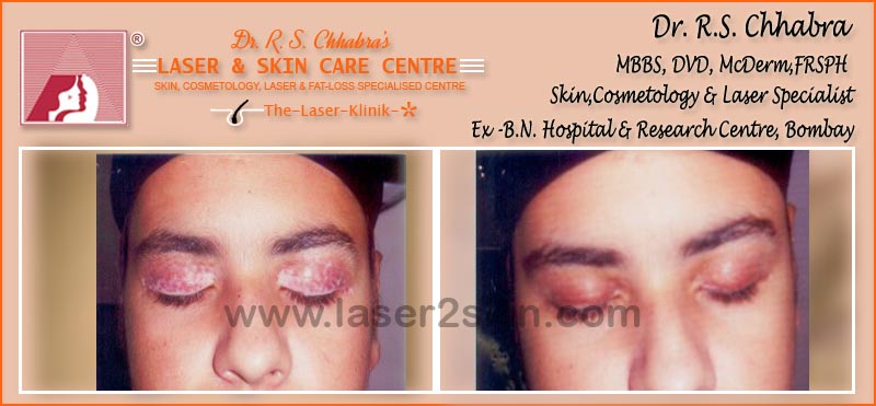Vitiligo(Leucoderma) Psoriasis With Microphototherapy spot Light Laser by Dr R.S. Chhbara Vitiligo(Leucoderma) Psoriasis With Microphototherapy spot Light Laser by Dr R.S. Chhbara