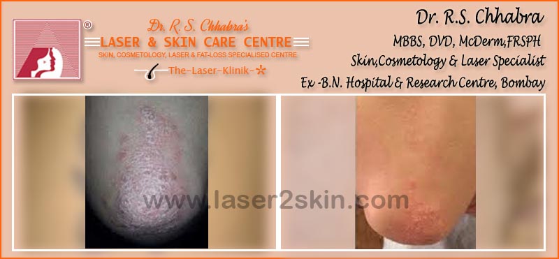 Vitiligo(Leucoderma) Psoriasis With Microphototherapy spot Light Laser by Dr R.S. Chhbara