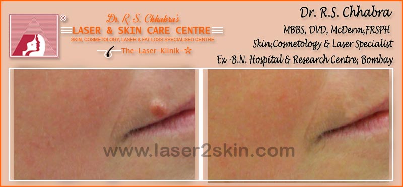 Warts, Moles, Corns, Freckles Treatment With Radio-Freq. Cauterisation by Dr R.S. Chhbara Warts, Moles, Corns, Freckles Treatment With Radio-Freq. Cauterisation by Dr R.S. Chhbara