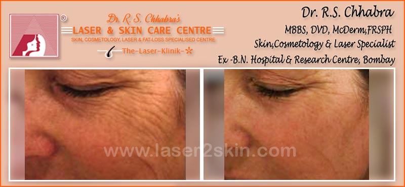 Wrinkles treatment by Dr R.S. Chhbara with IPL & E-Light laser Wrinkles treatment by Dr R.S. Chhbara with IPL & E-Light laser