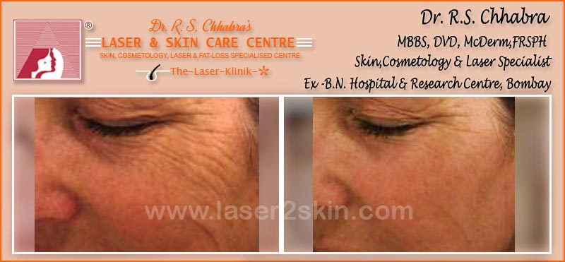 Wrinkles treatment by Dr R.S. Chhbara with IPL & E-Light laser