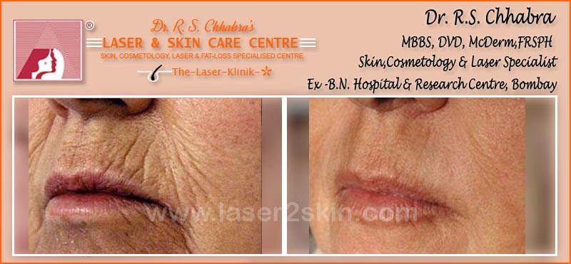 Wrinkles treatment by Dr R.S. Chhbara with laser Wrinkles treatment by Dr R.S. Chhbara with IPL & E-Light laser
