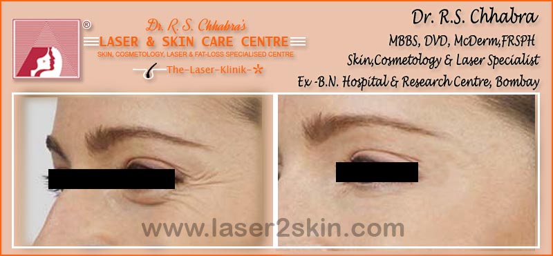 Wrinkles, Crows Feet, Frawn Lines treatment With Fillers by Dr R.S. Chhbara Wrinkles, Crows Feet, Frawn Lines treatment With Fillers by Dr R.S. Chhbara