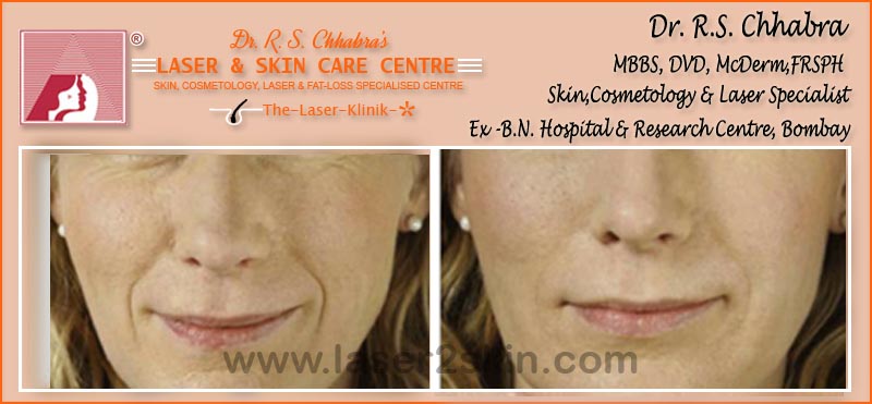 Wrinkles, Crows Feet, Frawn Lines treatment Wrinkles, Crows Feet, Frawn Lines treatment